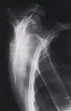 Posición Lateral Escápula